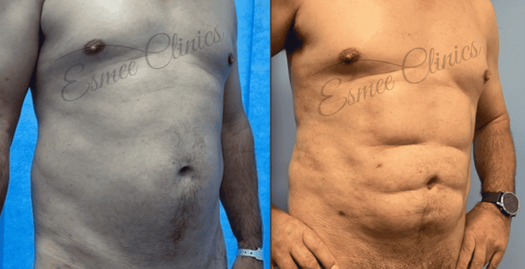 Before and After img